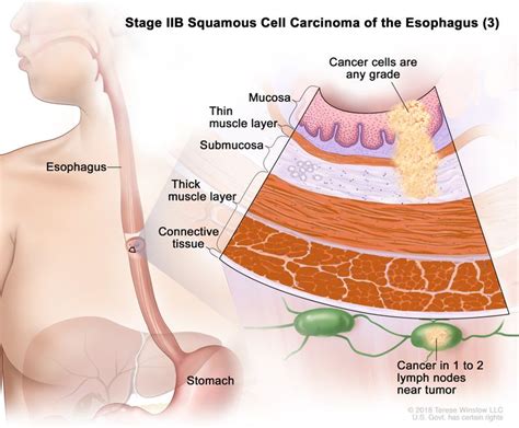 Esophageal Cancer Treatment Pdq® Nci