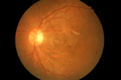 Neovascularization: The Growth of New Blood Vessels in the Retina