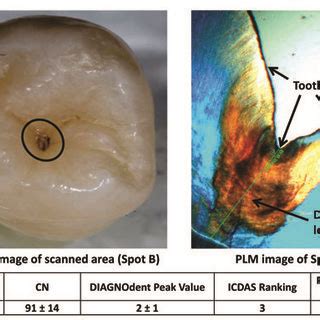 Lesion On Occlusal Surface Canary DIAGNODent ICDAS And PLM