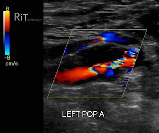 RiT radiology: Popliteal Artery Aneurysm