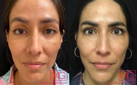 Restylane For Under Eyes Eye Rejuvenation