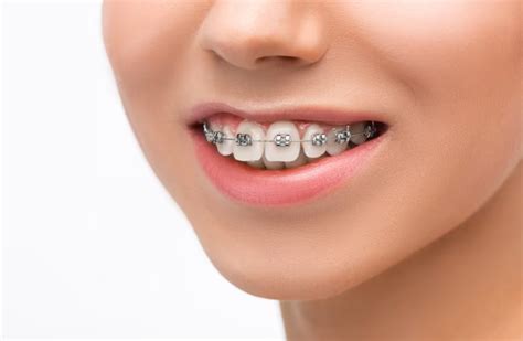 What Are Clear Aligners And How Do They Work