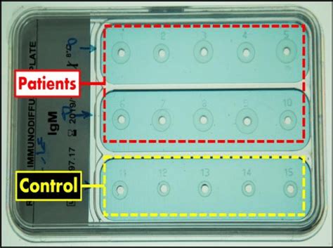 Radial Immunodiffusion Plate Shows The Differences Between The Patients