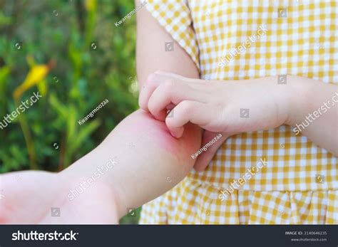 754 Baby Have Rash Images, Stock Photos & Vectors | Shutterstock