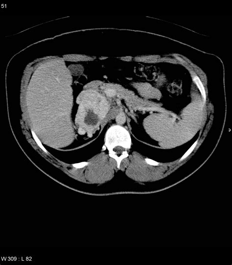 Symptoms Of An Adrenal Tumor Bdabuster