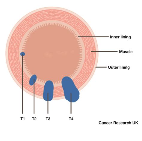 What is bowel cancer - Marie Keating Foundation