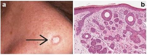 Infundibulocystic Basal Cell Carcinoma A Skin Lesion B Histology Download Scientific