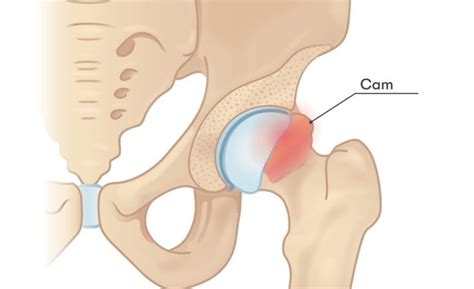 Femoroacetabular Impingement Fai Range Physiotherapy