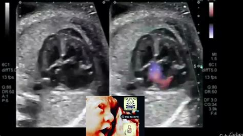 Truncus Arteriosus Fetal Ultrasound By Drhaissam Aref Dms Msc Md