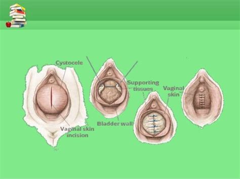 Uterine Prolapse Management 24 638 638×479 Assoalho Pélvico