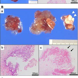 Representative Cases Of Macro And Microscopic Morphology Of Embolic