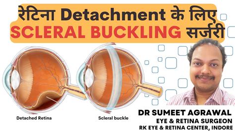 Retinal Detachment surgery by Scleral Buckling कस करत ह SCLERAL