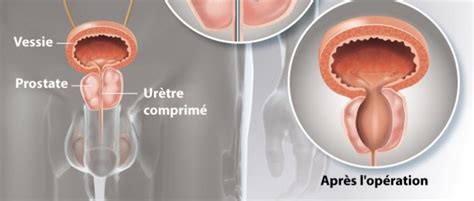 L adénome de la prostate expliqué par l urologue Stéphane Adjiman