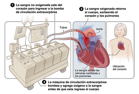 Cirug A Card Aca Qu Esperar Durante La Cirug A Nhlbi Nih