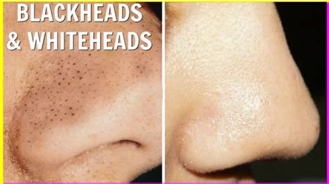 How To Remove Blackheads And Whiteheads At Home 3 Methods Beauty