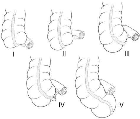 The Function Of Vermiform Appendix