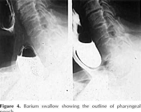 Figure 4 From Pharyngeal Pouch Zenker S Diverticulum A Review