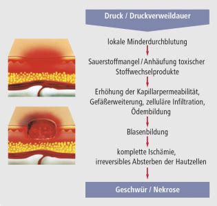 Expertenstandard Dekubitusprophylaxe In Der Pflege