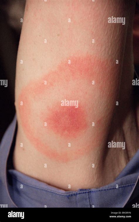 Close Up Of Pathognomonic Erythematous Rash Of Lyme Disease In The Pattern Of A “bulls Eye