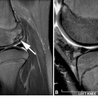 A B A Corresponding T Fat Saturated Mr Image In Sagittal View Shows