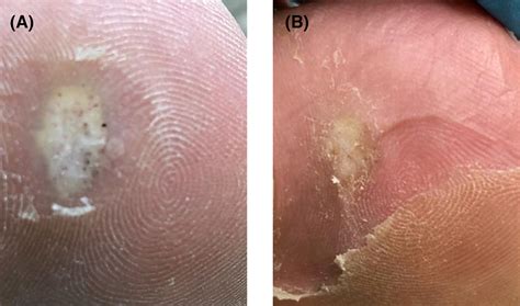 The Treatment Of Plantar Warts Using Microwave—a Review Of 85