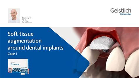 Soft Tissue Augmentation Around Dental Implants Case Youtube