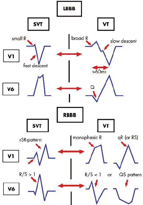 Wide Qrs Complex Tachycardia