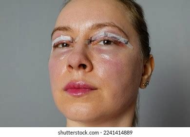 Woman Face After Plastic Surgery Blepharoplasty