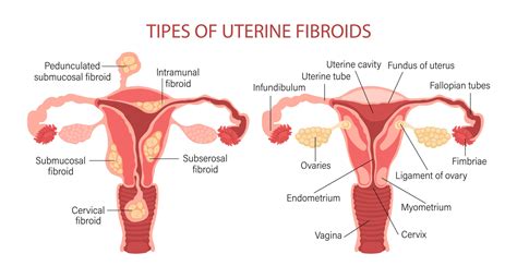 Types Of Uterine Fibroids In Women Fibroids Diseases Of The Female