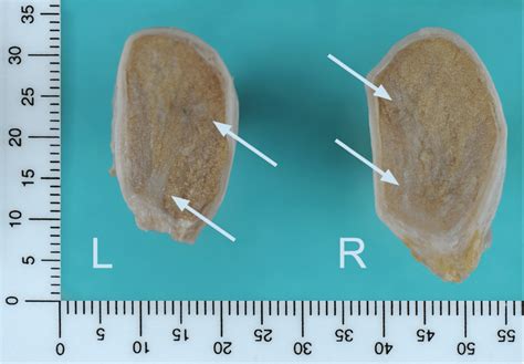 Cross Section Of The Left L And Right R Testis With Degenerative