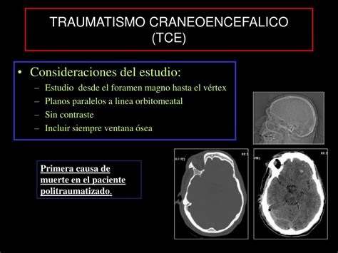 PPT TRAUMATISMO CRANEOENCEFALICO TCE PowerPoint Presentation Free