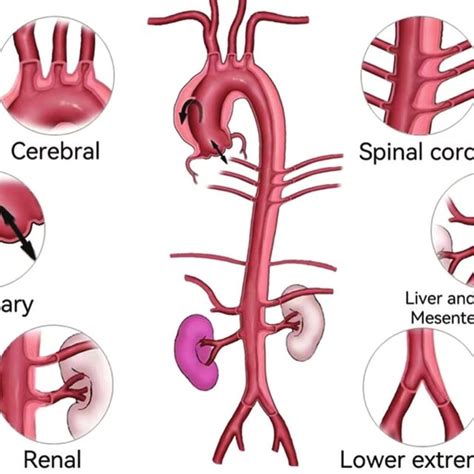 Flow Chart For Creation Of A Risk Scoring System Of Acute Type A Aortic