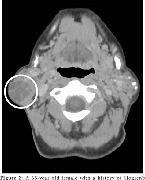 Figure 2 From Parotid Sebaceous Lymphadenoma Associated With Sjogrens Syndrome Review Of