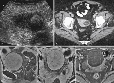 Magnetic Resonance Guided Ultrasound Surgery Of Uterine Leiomyomas