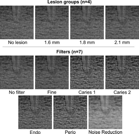 Artificial Intelligence For Detection Of Periapical Lesions On