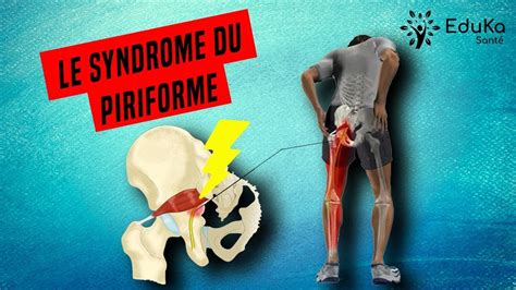 Soigner Le Syndrome Du Piriforme Explications Et Exercices Youtube