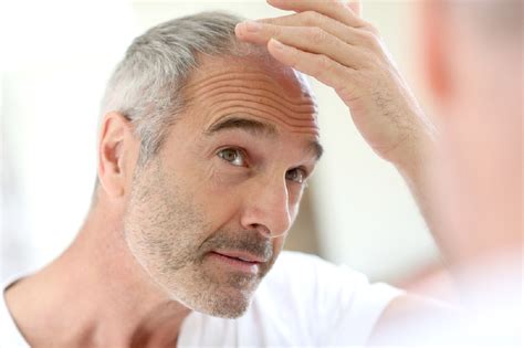 Male Hair Loss Causes And Treatment Options Dhi India