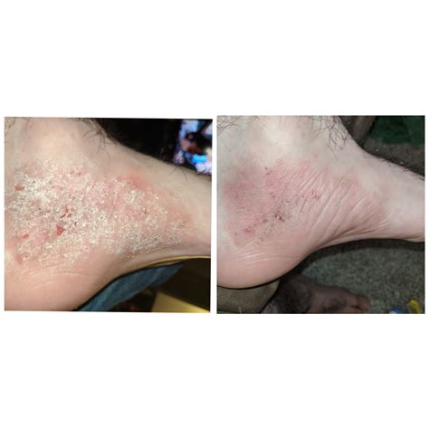 3 Days Of Using Off The Shelf Triamcinolone Acetonide Cream Much Less Burning And Much Less