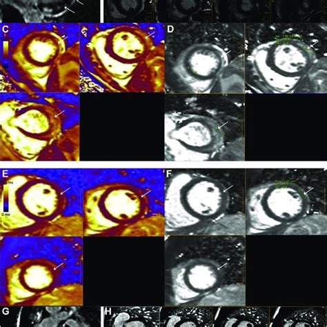 Cardiac Magnetic Resonance Cmr Imaging On 15t A B Late