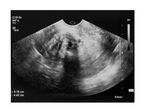 Uterine Fibroids Ultrasound