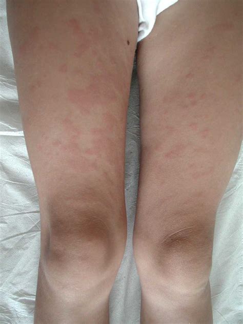 Rash Orticarioide Alla Nascita E Malattia Infiammatoria Cronica