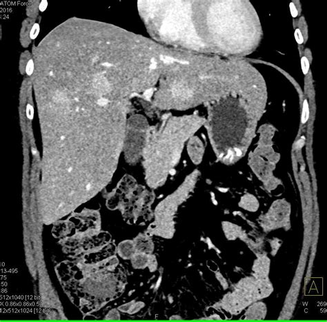 Metastatic Carcinoid Tumor To The Liver Liver Case Studies Ctisus