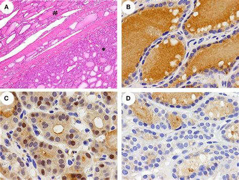 Histopathological Features And Immunohistochemical Detection Of Nrf