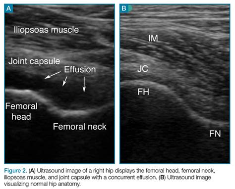 Anterior Hip Joint Ultrasound