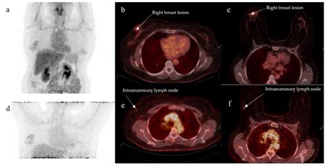 Diagnostics Free Full Text Prone Versus Supine Fdg Pet Ct In The