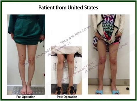 The Drawback of having bowlegs : Part 1 - Bangkok Advanced Clinics