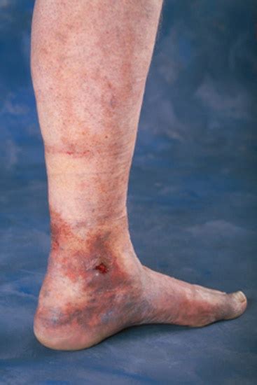 Bleeding Varicose Veins - Top Varicose Vein Treatment NYC