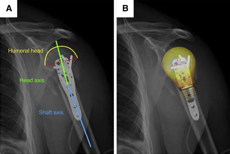 Fluoroscopic Technique For Open Reduction And Internal Fixation Of