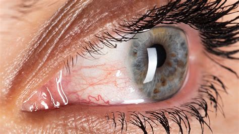 Uveitis Unveiled Understanding Symptoms Causes And Treatment Options