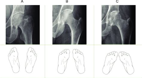 Hip X Ray Taken With Leg In A External Rotation B Internal